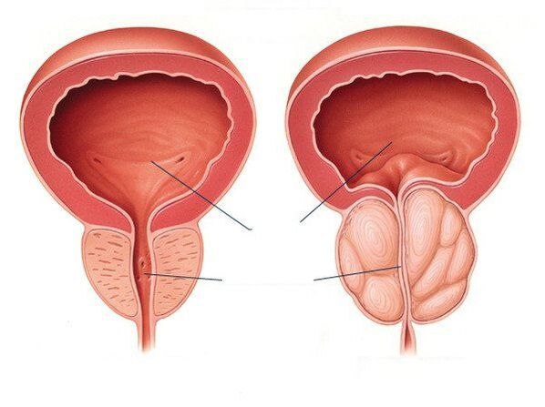 zdravá a chorá prostata